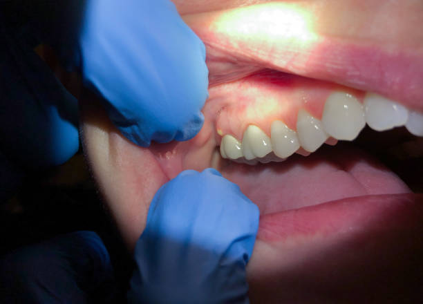 Best Emergency Dentist for Lost Fillings or Crowns in Rhome, TX